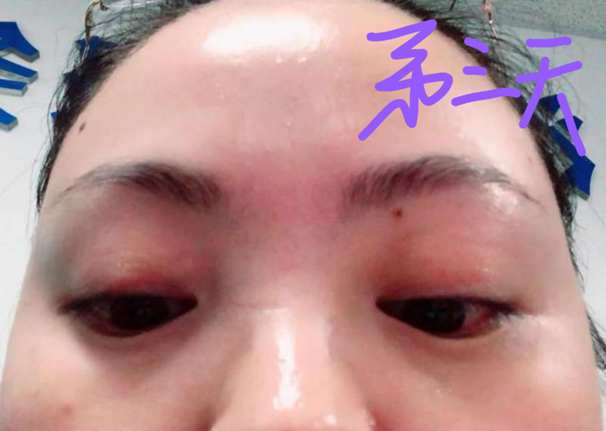 治疗偷针眼的案例